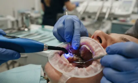 Gloved hands using a blue curing light to set a filling in a patient's back tooth